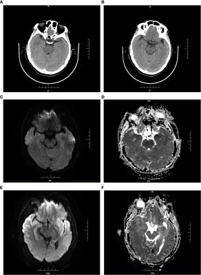 Intracerebral opportunistic infections caused by immunosuppressants after orthotopic liver transplantation: Report of two cases and literature review